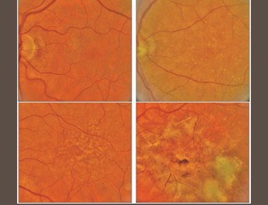 Examples of fundus images showing age-related macular degeneration