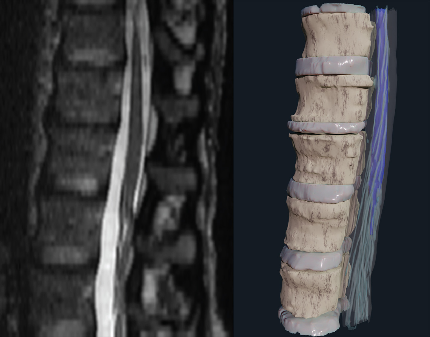 An APL team developed a pipeline for converting 2D MRI imagery (left) into 3D visualizations (right) to help surgeons place implants that help restore motor control to people with spinal cord injuries.