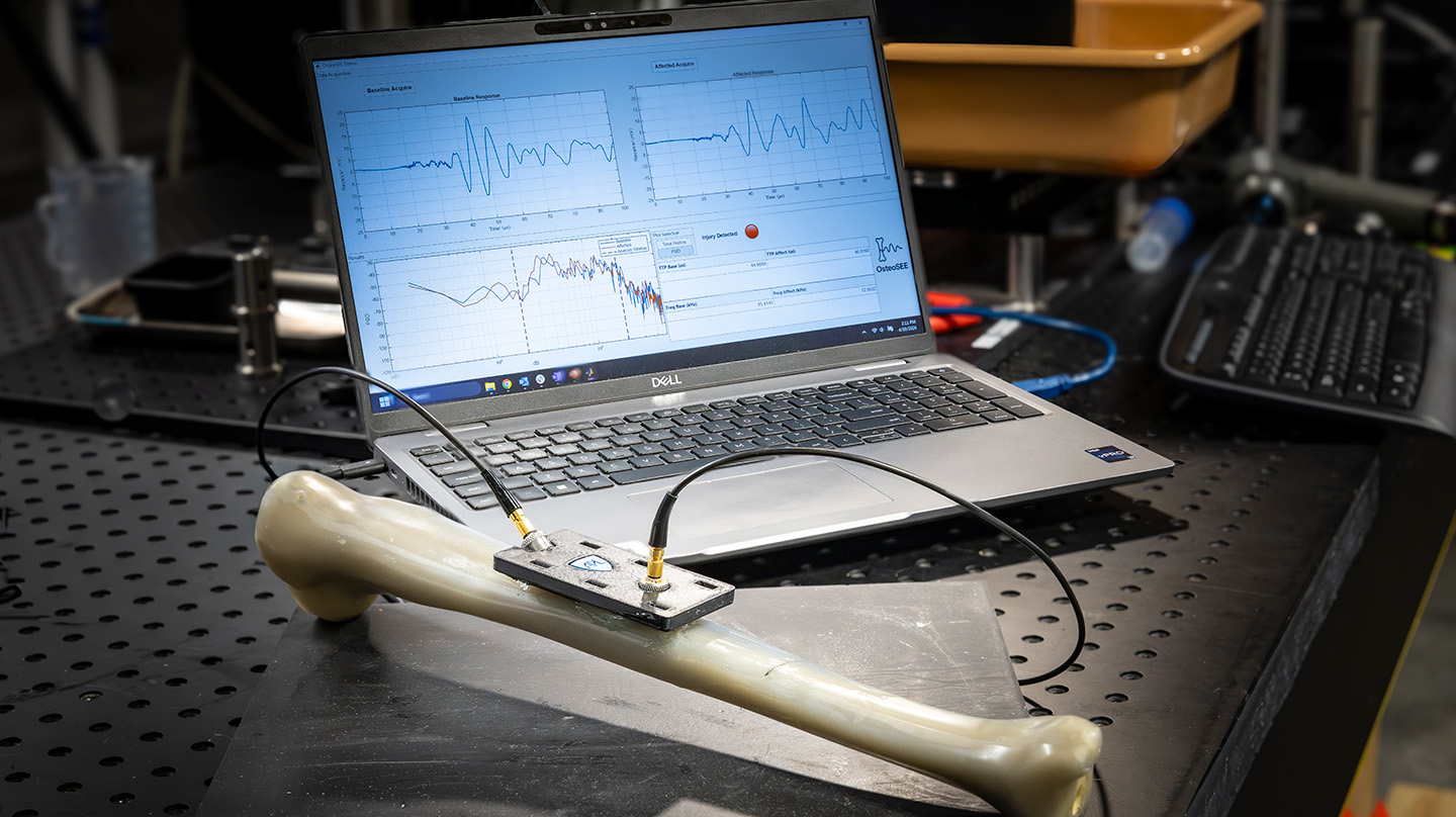 OsteoSEE is an ultrasound-based platform that enables early, noninvasive detection of tibial stress fractures using surface acoustic waves.